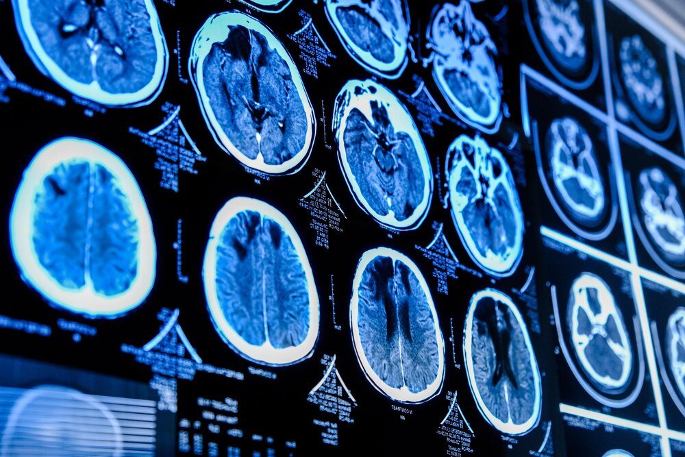 Rezonans magnetyczny mózgu: wskazania i przeciwwskazania