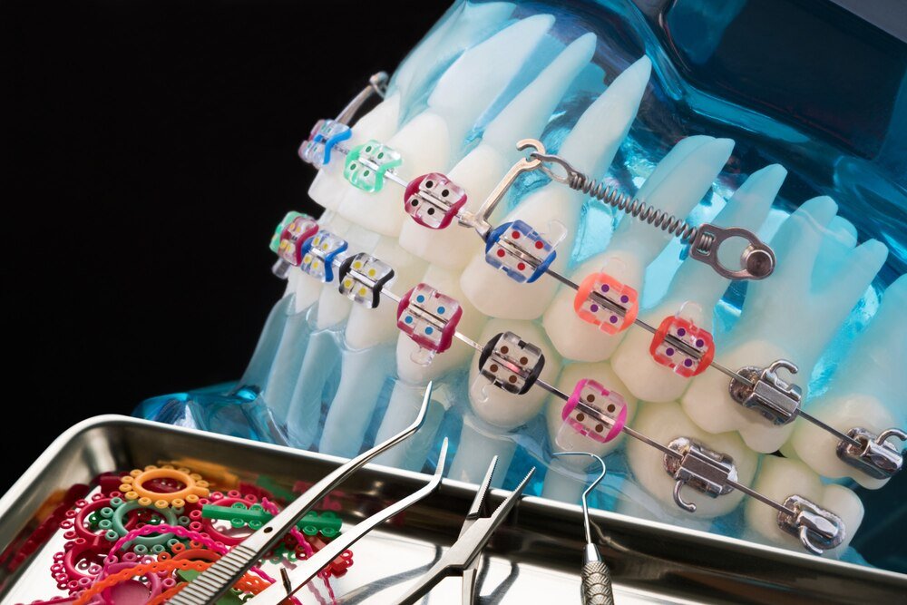 Ile kosztuje ściągnięcie aparatu ortodontycznego – przykładowe ceny